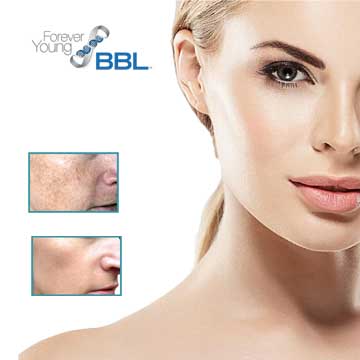 Antiaging teknolojisi BBL Forever Young