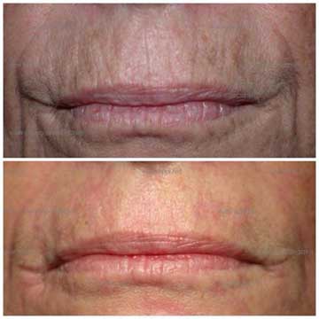 Antiaging Technology Plexr Before and After Skin Rejuvenation, Spot Treatment and Wrinkle Treatment