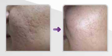 Antiaging Technology Scarlet S non-operative skin rejuvenation, Skin Rejuvenation and Wrinkles Before and After