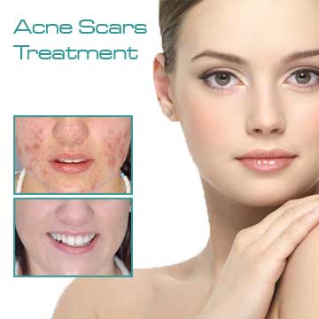 Skin treatment acne scars red acne treatment with fraxel laser
