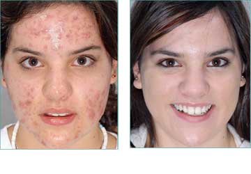 Skin treatment acne scars red acne treatment with fraxel laser