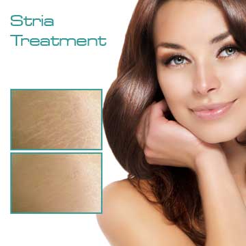 Skin treatment Stria Treatment with fraxel laser