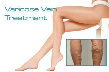 Vascular Treatments Varicose Vein Treatment Detail Information