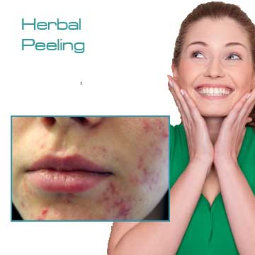 Peeling Applications for Skin Rejuvenation, Skin Renewal and Skin Care Green Peel Herbal Peeling Detail Information