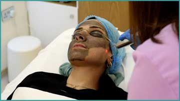 Skin Renewal and Skin Care Q-Switched Nd:Yag Laser Carbon Peeling Detail Information