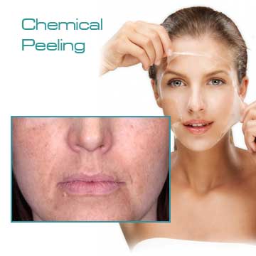 Skin Renewal Chemical Peeling TCA Peel Detail Information