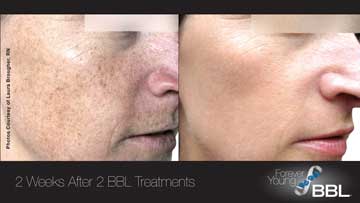 Antiaging Technology BBL Forever Young Before and After