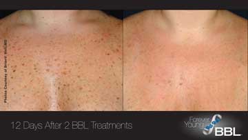 Antiaging Technology BBL Forever Young Before and After