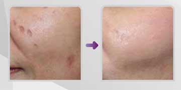 Antiaging Technology Scarlet S non-operative skin rejuvenation, Skin Rejuvenation and Wrinkles Before and After