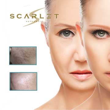 Antiaging Technology Scarlet S non-operative skin rejuvenation, Skin Rejuvenation and Wrinkles