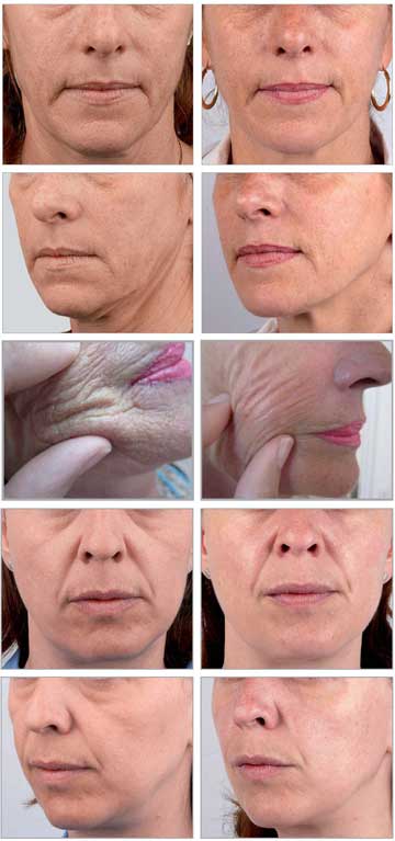 Wrinkle Treatmensts with Anti-aging Filling Applications Light Filling Redensity I Detail Information