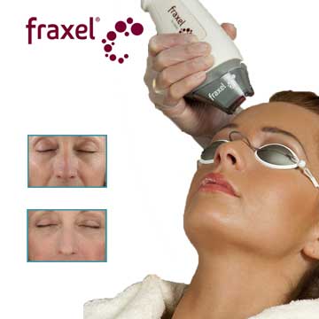 Antiaging Skin Renewal what is Fractional (Fraxel) Laser?