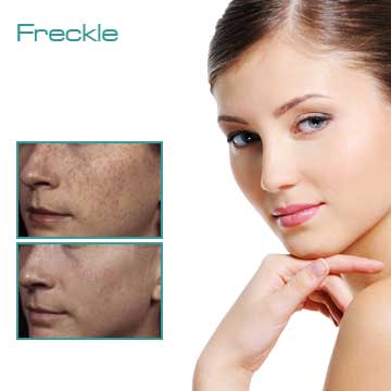 Spot Treatment Skin Rejuvenation Skin Care Applications Skin Renewal Skin Spots Freckle