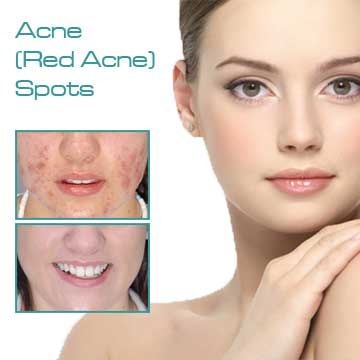 Spot Treatment Skin Rejuvenation Skin Care Applications Skin Renewal Skin Spots Acne (Red Acne) Spots