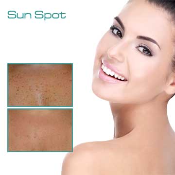 Spot Treatment Skin Rejuvenation Skin Care Applications Skin Renewal Skin Spots Sun Spots