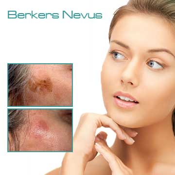 Spot Treatment Skin Rejuvenation Skin Care Applications Skin Renewal Skin Spots Becker’s Nevus