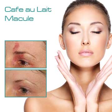 Spot Treatment Skin Rejuvenation Skin Care Applications Skin Renewal Skin Spots Cafe au Lait Macule