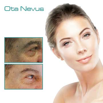 Spot Treatment Skin Rejuvenation Skin Care Applications Skin Renewal Skin Spots Ota Nevus