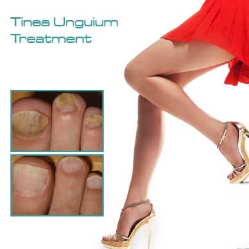 Skin treatment Tinea Unguium Treatment