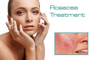 Vascular Treatments Rosacea Treatment Detail Information