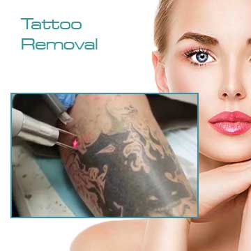Your color and black tattoo may be removed with Q-Switched Nd YAG Laser