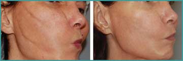 Antiaging Skin Renewal Collagen Mesotherapy LinErase Detail Information