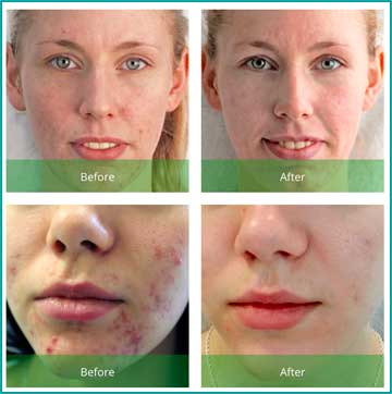 Peeling Applications for Skin Rejuvenation, Skin Renewal and Skin Care Green Peel Herbal Peeling Detail Information