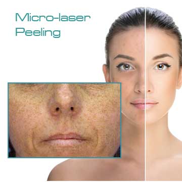 Micro-laser Peeling MLP Peeling Applications for Skin Rejuvenation, Skin Renewal and Skin Care