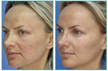 Micro-laser Peeling MLP Peeling Applications for Skin Rejuvenation, Skin Renewal and Skin Care Before and After